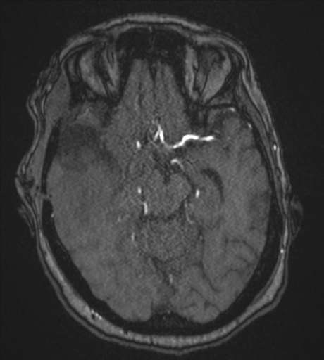 Atypical meningioma (WHO Grade II) (Radiopaedia 54742-60981 Axial MRA 39).png