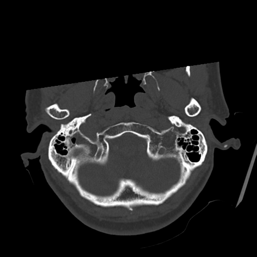 Atypical meningioma with skull invasion (Radiopaedia 34357-35649 Axial bone window 12).png
