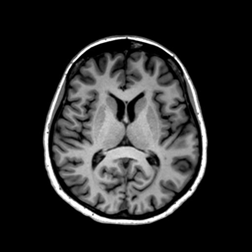 Autoimmune limbic encephalitis (Radiopaedia 30363-31005 T1 Axial 1mm 84).jpg