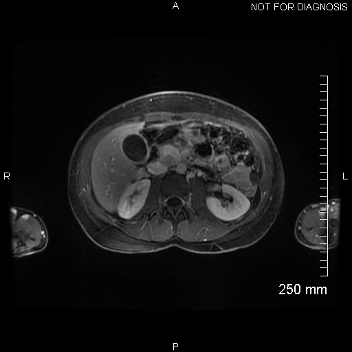 Autoimmune pancreatitis (Radiopaedia 88443-105101 A 75).jpg
