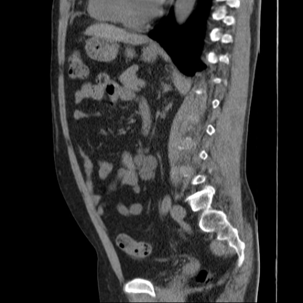 File:Autosomal dominant polycystic kidney disease (Radiopaedia 36539-38101 D 50).jpg