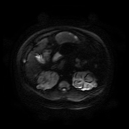 Autosomal dominant polycystic kidney disease (Radiopaedia 50259-55611 Axial DWI 90).jpg