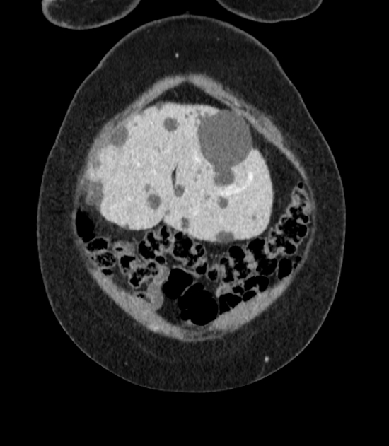 Autosomal dominant polycystic kidney disease (Radiopaedia 57124-64017 B 8).jpg