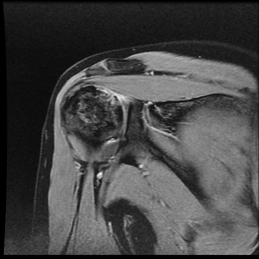 Avascular necrosis of humerus (Radiopaedia 58924-66174 H 37).jpg