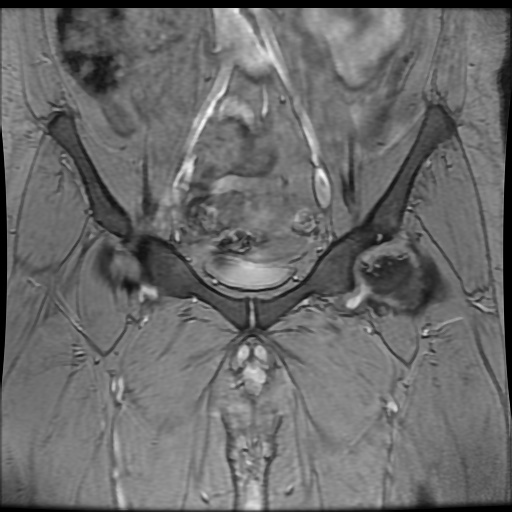 Avascular necrosis of the hip (Radiopaedia 61503-69465 F 25).jpg