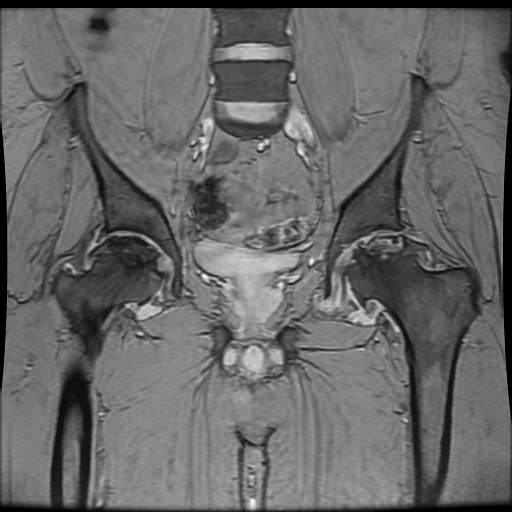 Avascular necrosis of the hip (Radiopaedia 61503-69465 F 45).jpg