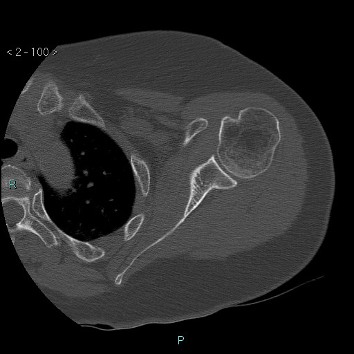 File:Avascular necrosis of the shoulder - Cruess stage I (Radiopaedia 77674-89887 Axial bone window 25).jpg