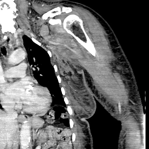 File:Axillary arterial pseudoaneurysm (Radiopaedia 24925-25195 B 2).jpg