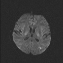 Balo concentric sclerosis (Radiopaedia 50458-55940 Axial DWI 56).jpg