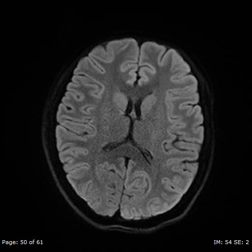 Balo concentric sclerosis (Radiopaedia 61637-69636 Axial DWI 50).jpg