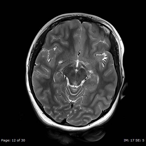 File:Balo concentric sclerosis (Radiopaedia 61637-69636 Axial T2 12).jpg