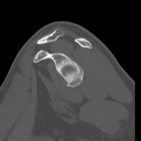 Bankart lesion (Radiopaedia 57256-64185 Sagittal bone window 29).jpg