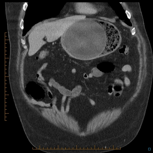 File:Bariatric balloon causing gastric outlet obstruction (Radiopaedia 54449-60672 B 12).jpg