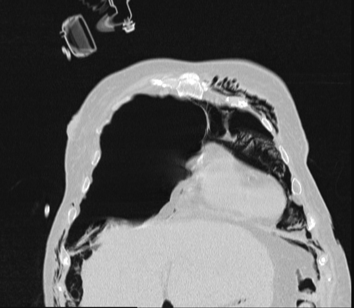 Barotrauma due to mechanical ventilation (Radiopaedia 28079-28336 Coronal lung window 23).jpg