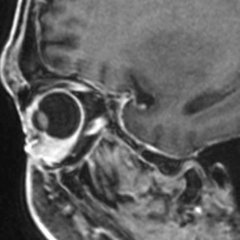 File:Basal cell carcinoma (periorbital) (Radiopaedia 55179-61559 F 10).jpg