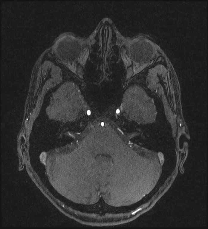 Basilar artery perforator aneurysm (Radiopaedia 82455-97733 Axial MRA 67).jpg
