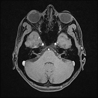Basilar artery perforator aneurysm (Radiopaedia 82455-97733 Axial T1 fat sat 36).jpg