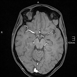 Basilar artery perforator aneurysm (Radiopaedia 82455-99523 F 59).jpg