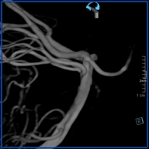 Basilar artery perforator aneurysm (Radiopaedia 82455-99524 3D Left VA 64).jpg