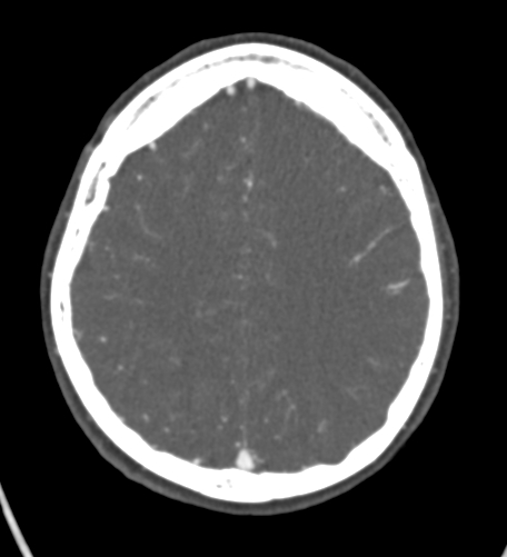 File:Basilar tip aneurysm with coiling (Radiopaedia 53912-60086 A 109).jpg