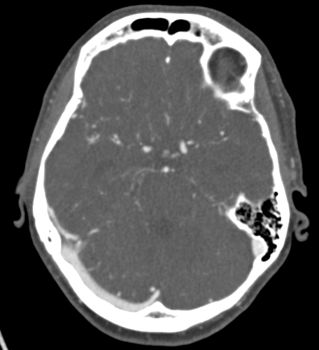 Basilar tip aneurysm with coiling (Radiopaedia 53912-60086 A 54).jpg