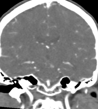 Basilar tip aneurysm with coiling (Radiopaedia 53912-60086 B 81).jpg