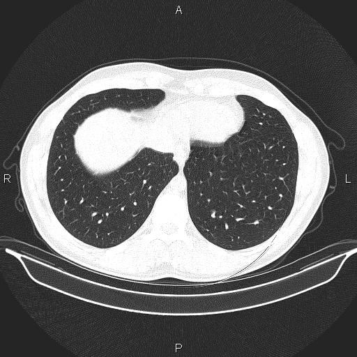 Beam hardening and ring artifacts (Radiopaedia 85323-100915 Axial lung window 60).jpg