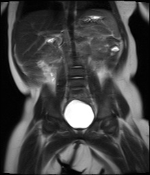 File:Beckwith-Wiedeman syndrome with bilateral Wilms tumors (Radiopaedia 60850-69233 Coronal T2 10).jpg