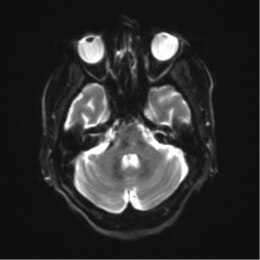 Behavioral variant frontotemporal dementia and late onset schizophrenia (Radiopaedia 52197-58083 Axial DTI Trace W 7).png
