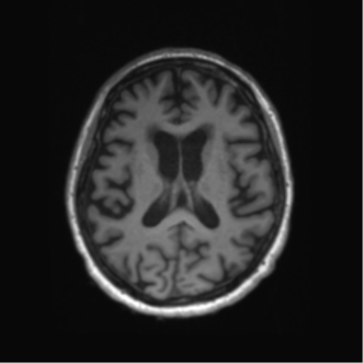 Behavioral variant frontotemporal dementia and late onset schizophrenia (Radiopaedia 52197-58083 Axial T1 40).png