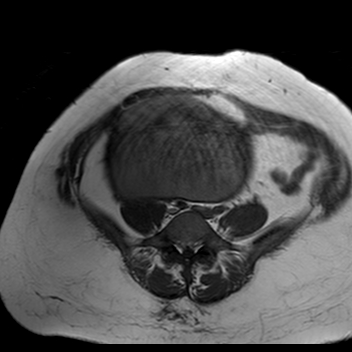 File:Benign seromucinous cystadenoma of the ovary (Radiopaedia 71065-81300 Axial T1 17).jpg