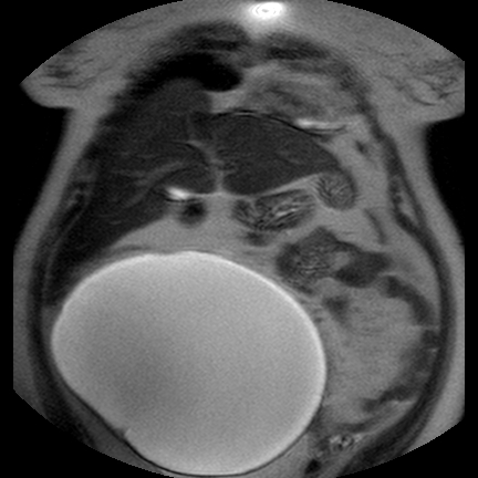 File:Benign seromucinous cystadenoma of the ovary (Radiopaedia 71065-81300 Coronal T2 15).jpg