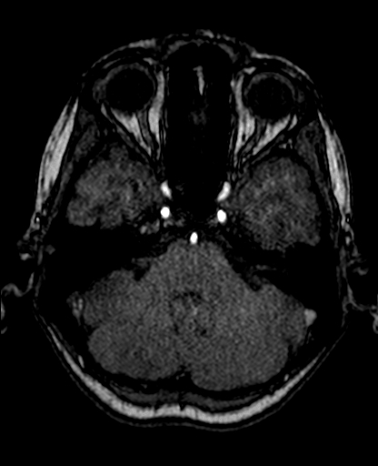 File:Berry aneurysm of the terminal internal carotid artery (Radiopaedia 88286-104918 Axial TOF 76).jpg