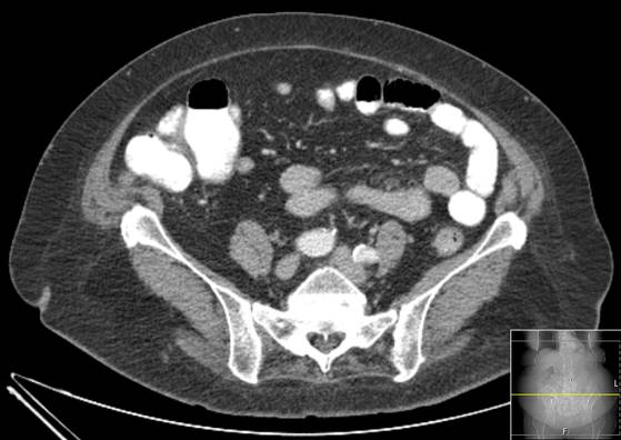 Bicameral celiacomesenteric aneurysm (Radiopaedia 55766-62327 A 46).jpg