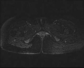 File:Bicornuate bicollis uterus (Radiopaedia 61626-69616 Axial PD fat sat 35).jpg