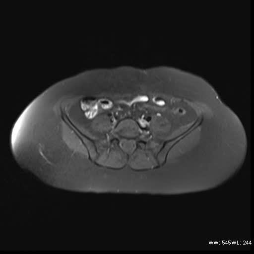 File:Bicornuate uterus- on MRI (Radiopaedia 49206-54297 Axial T1 fat sat 3).jpg