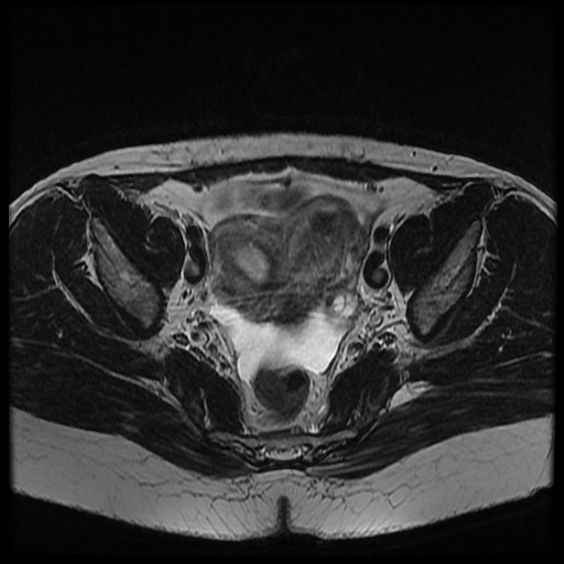 File:Bicornuate uterus (Radiopaedia 51676-57472 Axial T2 20).jpg