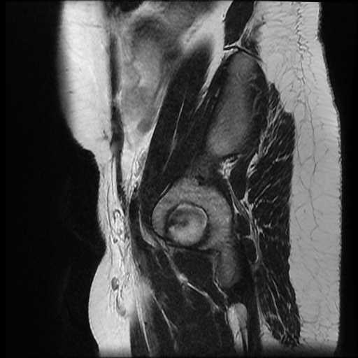 File:Bicornuate uterus (Radiopaedia 51676-57472 Sagittal T2 3).jpg