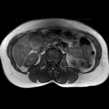 File:Bicornuate uterus (Radiopaedia 61974-70046 Axial T1 1).jpg
