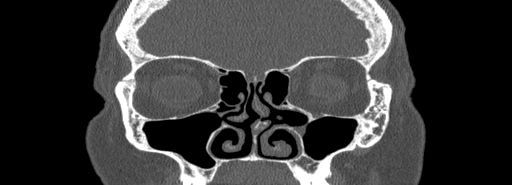 Bilateral Ectopic Infraorbital Nerves (Radiopaedia 49006-54084 Coronal bone window 27).jpg