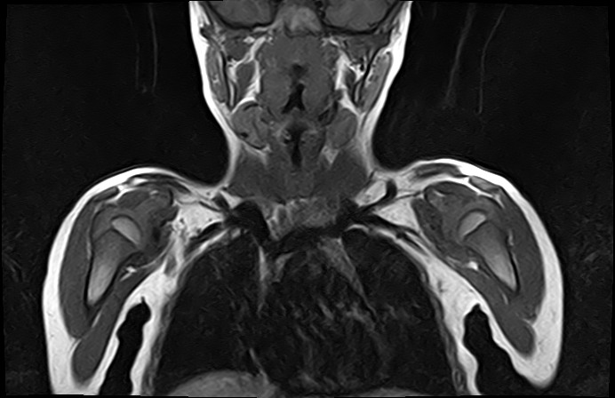 File:Bilateral Sprengel deformity with Klippel-Feil syndrome (Radiopaedia 66395-75650 Coronal T1 8).jpg
