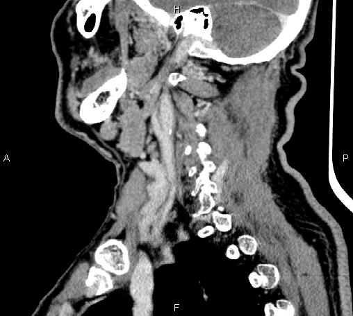 Bilateral Warthin tumors (Radiopaedia 84034-99263 D 31).jpg