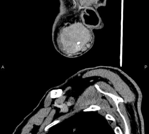 Bilateral Warthin tumors (Radiopaedia 84034-99263 D 69).jpg