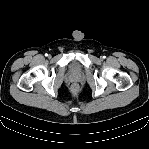 Bilateral accessory renal arteries with mild pelvi-ureteric junction (PUJ) obstruction (Radiopaedia 66357-75596 A 75).jpg