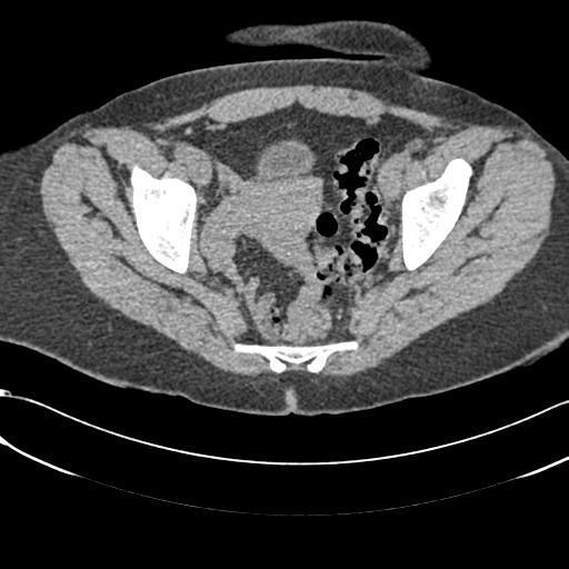 File:Bilateral acetabular protrusion with pincer type femoro-acetabular impingement (Radiopaedia 30134-30733 AXIAL SOFT THIN 15).jpg