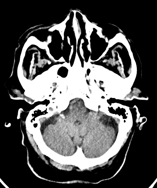 Bilateral acute on chronic subdural hematomas (Radiopaedia 78466-91146 Axial non-contrast 15).jpg