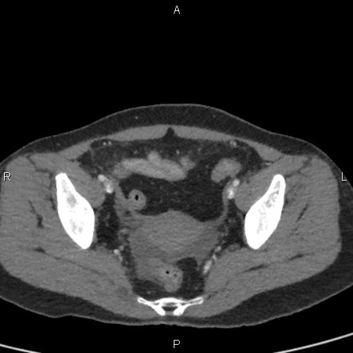 File:Bilateral adrenal gland hyperenhancement in pancreatitis (Radiopaedia 86642-102753 E 97).jpg