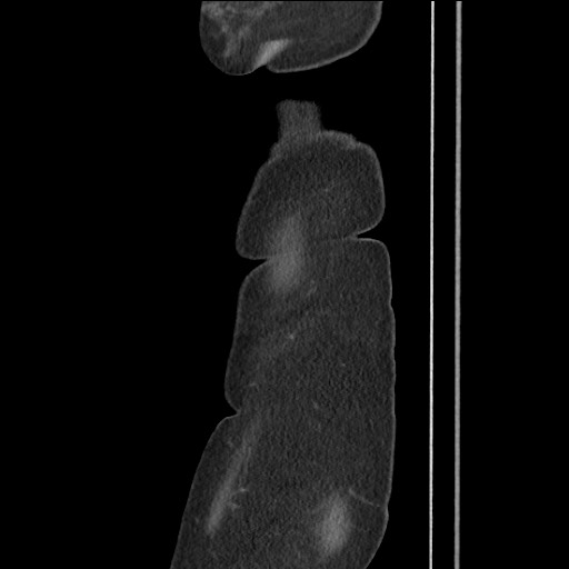 Bilateral adrenal granulocytic sarcomas (chloromas) (Radiopaedia 78375-91007 C 16).jpg