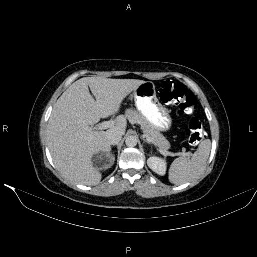 Bilateral adrenal myelolipoma (Radiopaedia 63058-71535 Axial C+ delayed 20).jpg