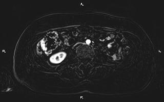 Bilateral adrenal myelolipoma (Radiopaedia 63058-71537 I 65).jpg